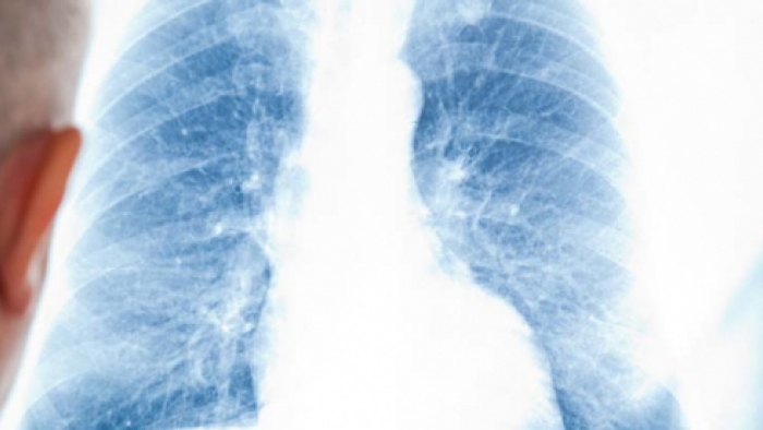 Akciğer Kanseri ve Belirtileri