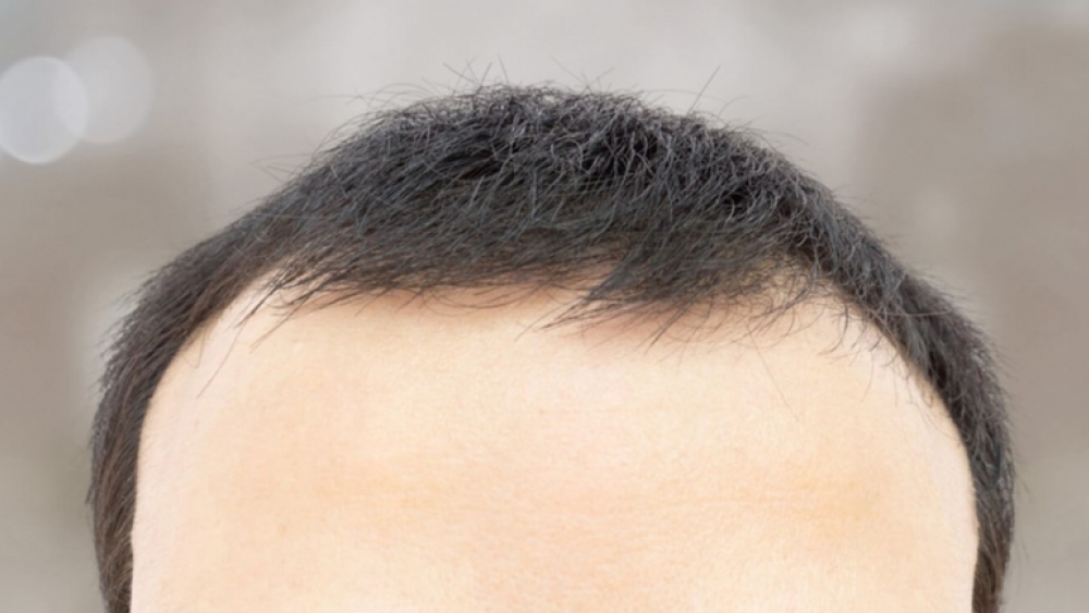 PRP saç tedavisi nedir?