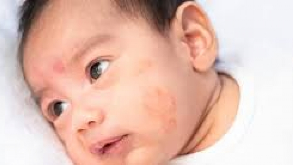 Atopik Dermatit Bebek Koruyucusu